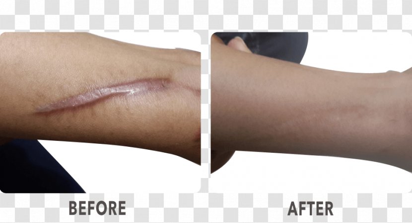 Nail Surgery Scar La Skinnovita- Dr. Anuj Pall Dermatology, Laser & Hair Centre - Sekhmet Transparent PNG