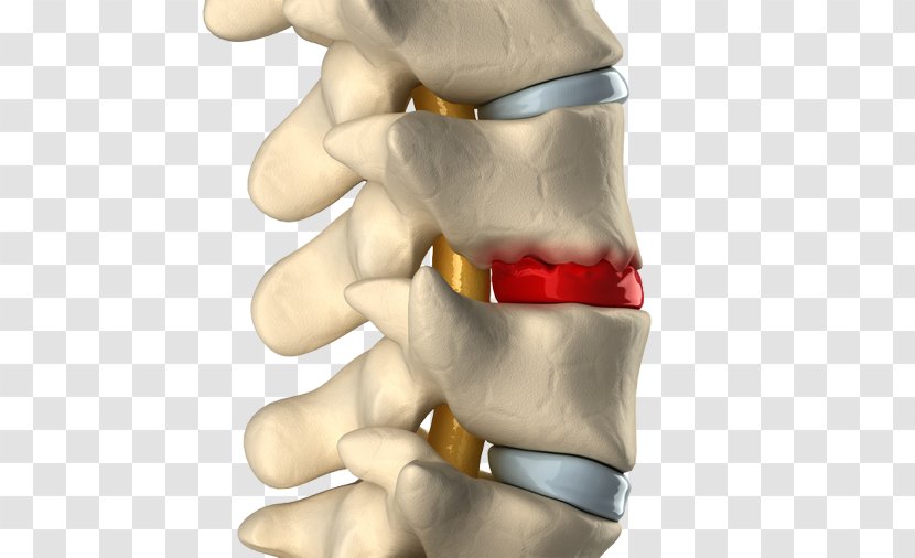 Spinal Disc Herniation Degenerative Disease Intervertebral Vertebral Column Osteophyte - Cartoon - Back Pain Transparent PNG