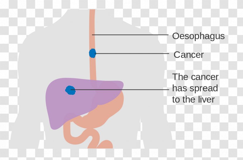 Esophageal Cancer Esophagus Dysphagia Disease - Frame - Basal Transparent PNG