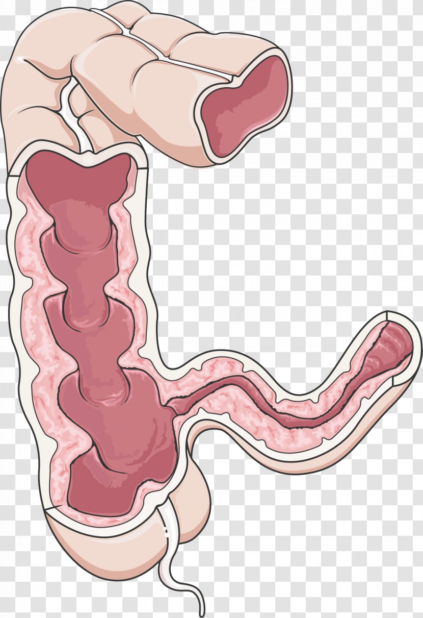 Crohn's Disease Large Intestine Gastrointestinal Tract Inflammatory Bowel - Tree - Frame Transparent PNG