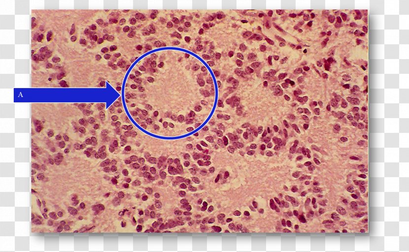 Pineocytoma Pinealoblastoma Playing Card Abnormality Thumb - Organism - Pineal Transparent PNG