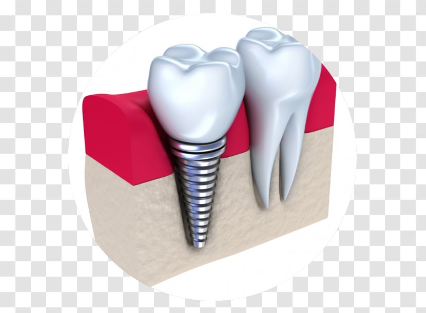 Dental Implant Dentistry Dentures - Silhouette Transparent PNG