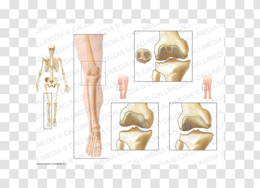 La Gonarthrose Knee Osteoarthritis Arthritis - Genu Varum - Artrosis De Rodilla Transparent PNG