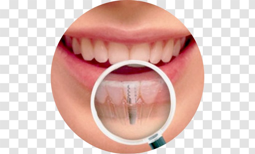 Dental Implant Human Tooth Dentistry - Close Up - Health Transparent PNG