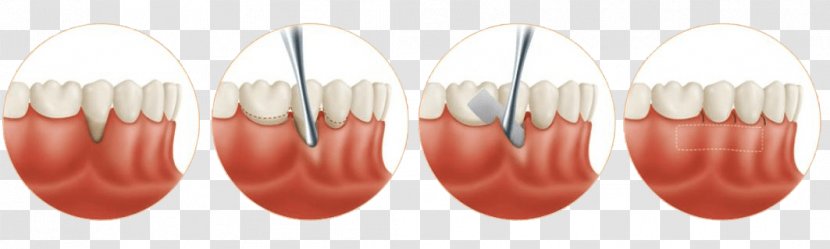 Gingival Graft Gums Soft Tissue Recession - Human Tooth - Therapy Transparent PNG