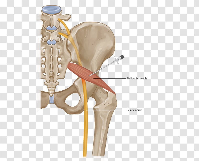 Piriformis Syndrome Muscle Injection Surgery Sciatica - Cartoon - Hip Pain Transparent PNG