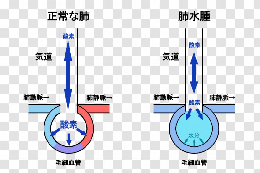 Pulmonary Edema Respiratory Sounds Breathing Lung Cough Transparent PNG