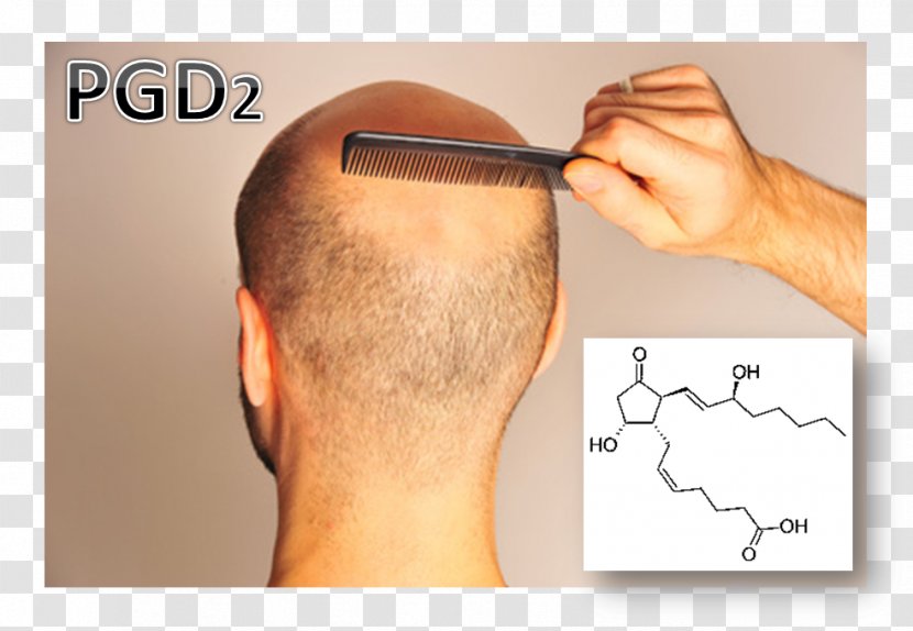 Hair Loss Prostaglandin D2 Scalp - Silhouette Transparent PNG