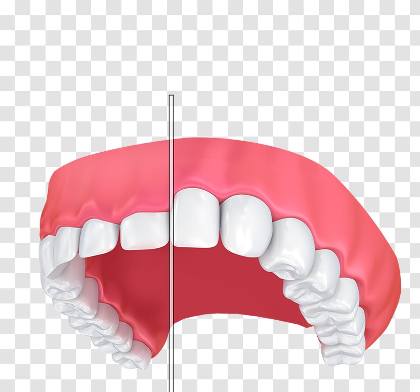 Gums Gum Lift Dentistry Tooth Gummy Smile - Jaw - Comfort Anxious Patients Transparent PNG