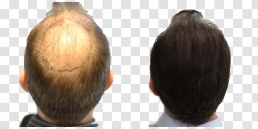 Hair Transplantation Follicular Unit Extraction Step Cutting Long - Prohairclinic Transparent PNG