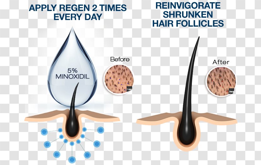 Minoxidil Management Of Hair Loss Follicle Human Growth - Skin Transparent PNG
