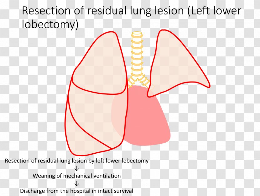 Congenital Pulmonary Airway Malformation Lobectomy Segmental Resection Surgery Lung - Watercolor - Aventura Institute Transparent PNG