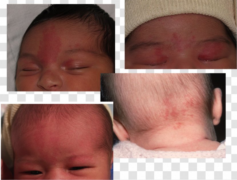 Nevus Flammeus Nuchae Infant Birthmark Sebaceous Gland - Jaw - Chin Transparent PNG