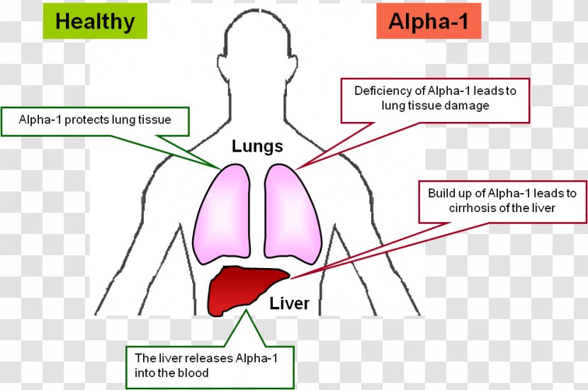 Chronic Obstructive Pulmonary Disease Health Lung Finger - Tree Transparent PNG