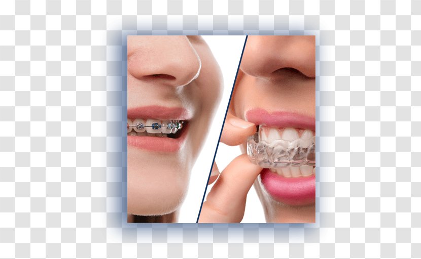 Clear Aligners Orthodontics Dental Braces Dentistry - Surgery - Orthodontist Transparent PNG