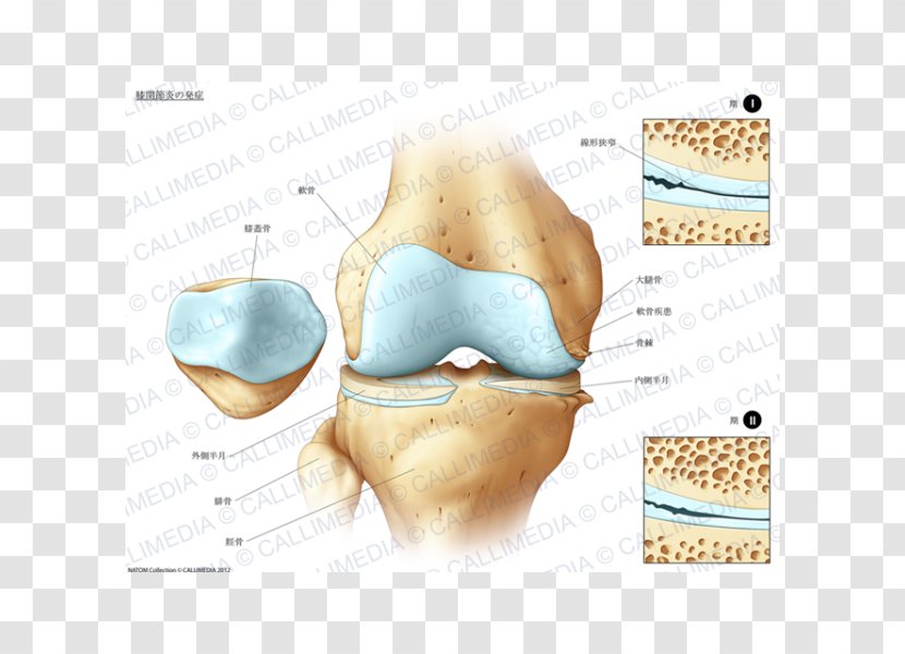 Tibia Knee Pain Bone Fracture Joint - Pathology - Artrosis De Rodilla Transparent PNG