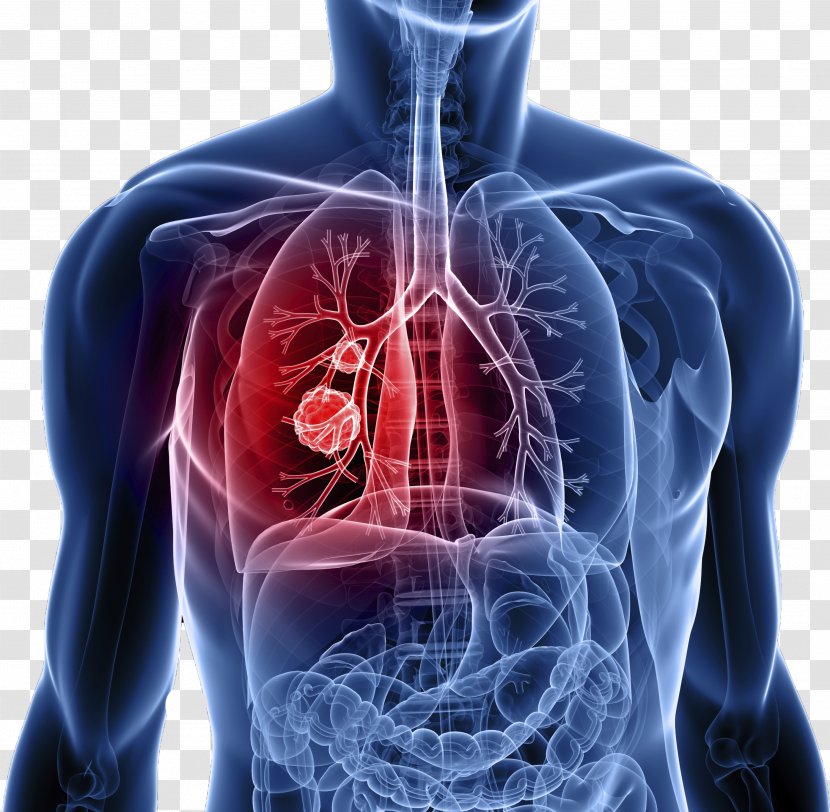 Lung Cancer Symptom Metastasis - Silhouette - Cell Bodies Transparent PNG
