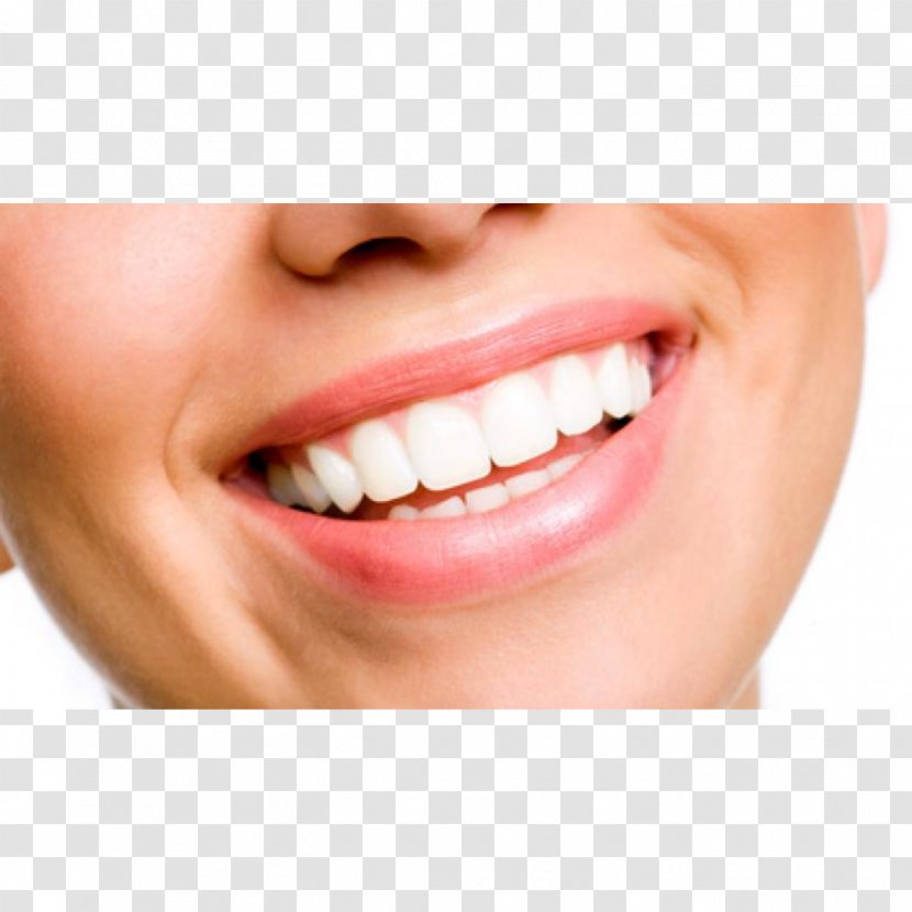 Tooth Whitening Cosmetic Dentistry Veneer - Crown Transparent PNG