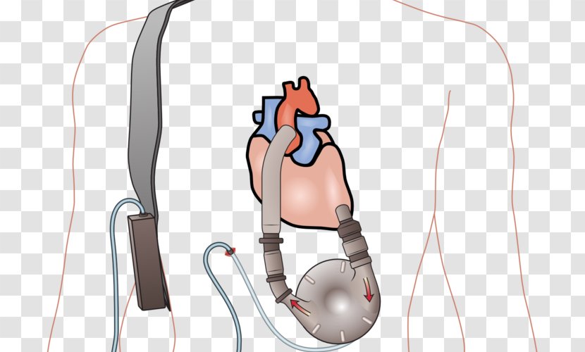 Ventricular Assist Device Heart Transplantation Ventricle Failure Transparent PNG