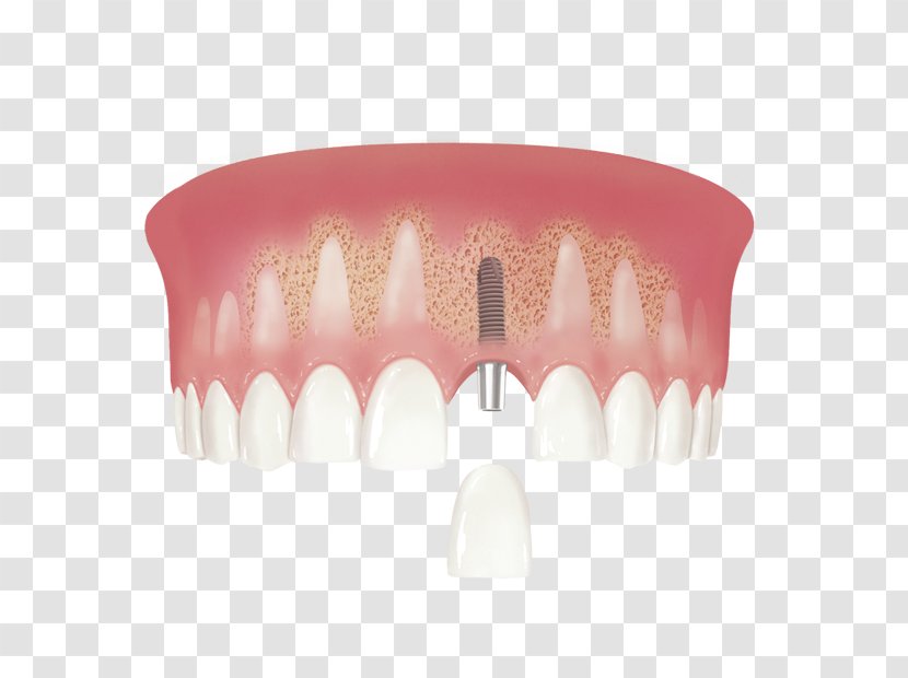 Human Tooth Dental Implant Implantology - Crown Transparent PNG