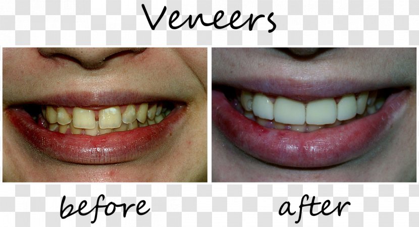Tooth Veneer Orthodontics Dentistry - Tongue - Crown Transparent PNG