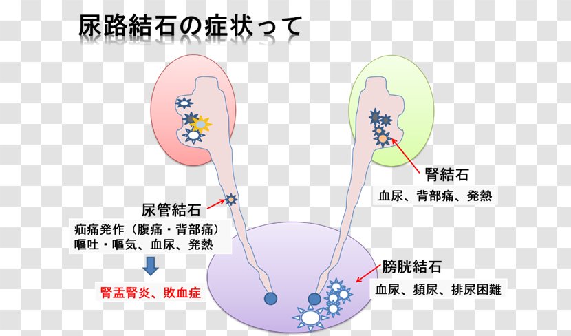 Kidney Stone Calculus Excretory System Urology Cancer - Ureter - Disease Transparent PNG