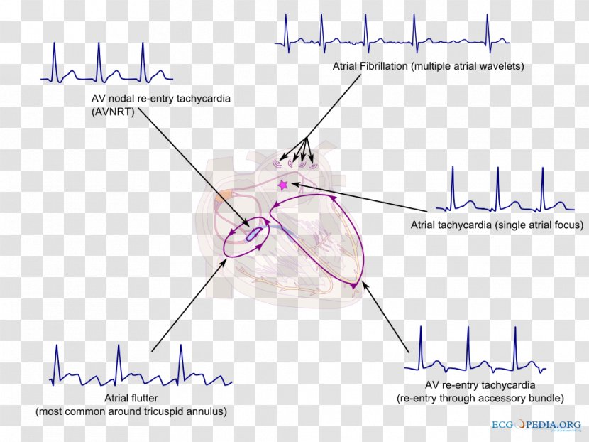 Supraventricular Tachycardia Heart Arrhythmia Atrial Fibrillation - Silhouette Transparent PNG