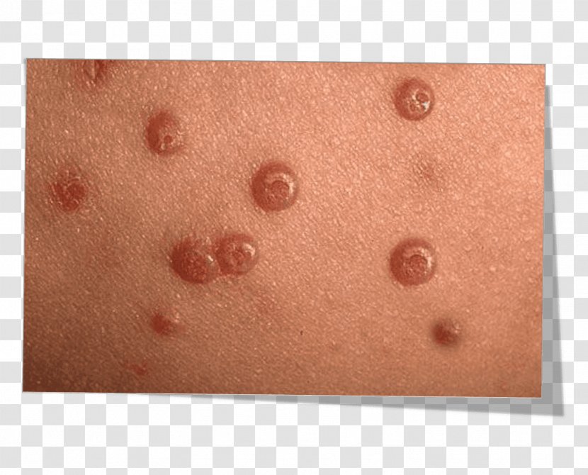 Molluscum Contagiosum Skin Wheal Pediatrics Infectious Disease - Child Transparent PNG