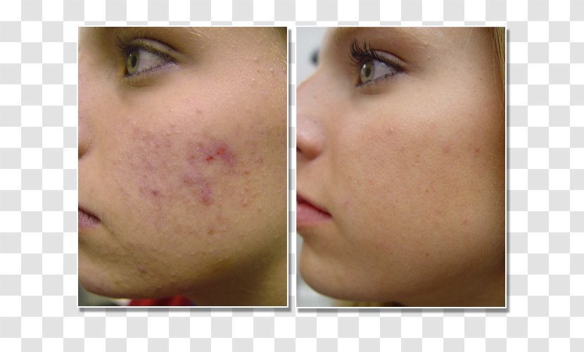 Scar Acne Chemical Peel LA SkinAesthetics Exfoliation - Cheek - Skin Clinic Transparent PNG