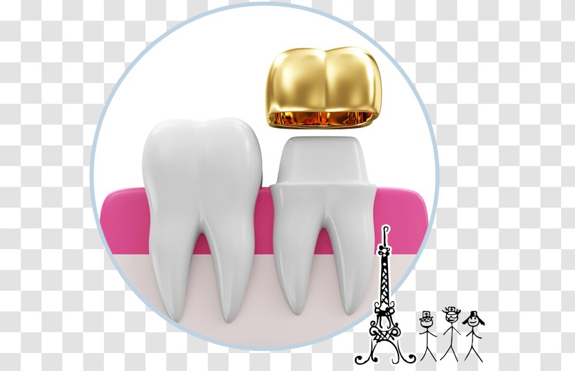 Tooth Crown Dentistry Prosthodontics Dental Implant - Silhouette Transparent PNG