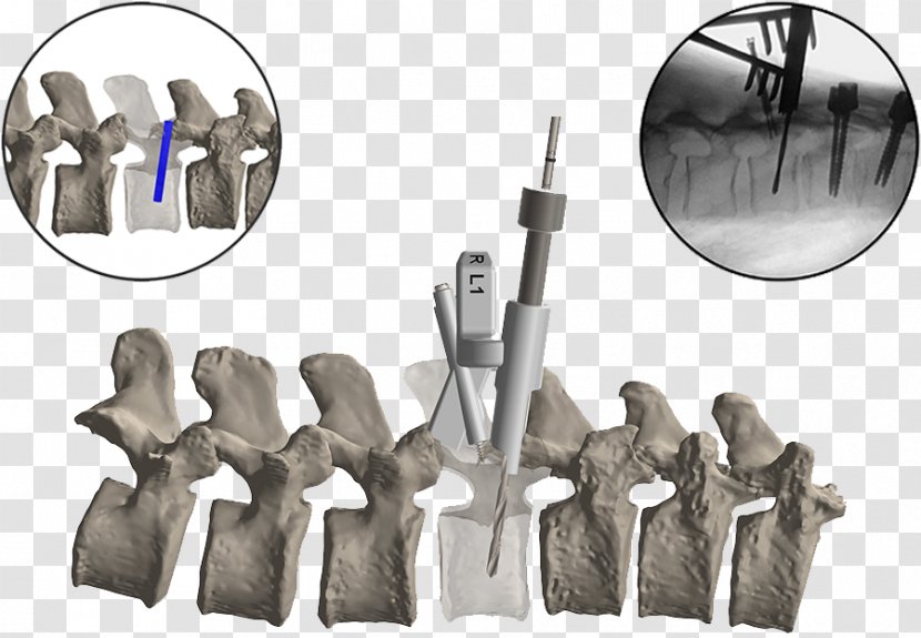 Vertebral Column Spinal Fusion Surgery Cervical Vertebrae Lumbar - Implant - Screw Transparent PNG