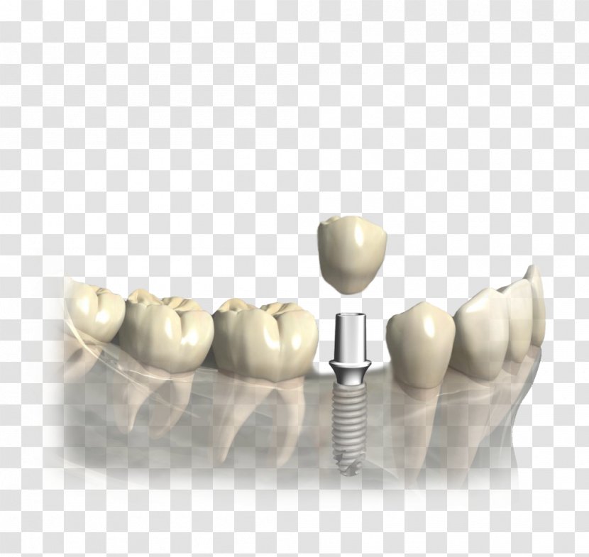 Tooth Dentistry Dental Implant Prosthesis - Korona Transparent PNG