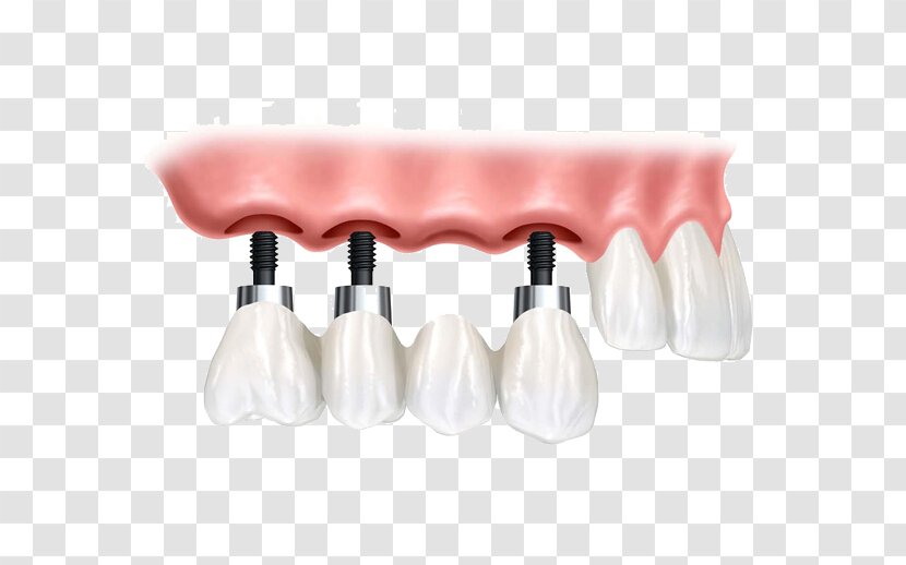 Dental Implant Dentistry Bridge - Health Beauty - Planting Teeth Picture Transparent PNG
