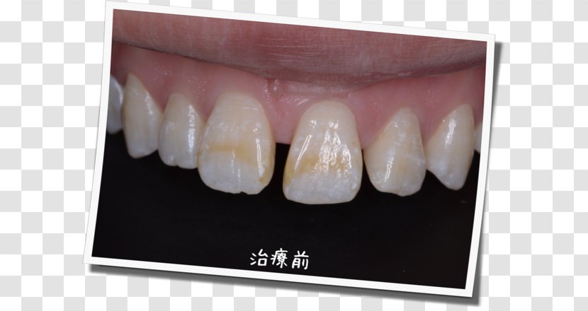 脱灰 Tooth Decay Enamel Therapy - Mouth - Dental Postcard Transparent PNG