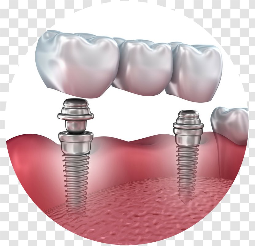 Bridge Dental Implant Dentistry Dentures - Silhouette Transparent PNG