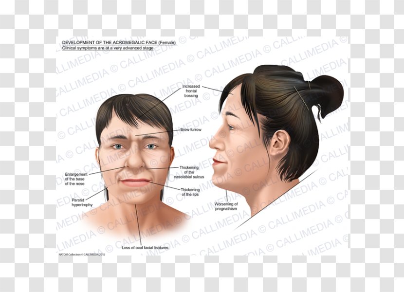 Acromegaly Face Gigantism Symptom Nose Transparent PNG