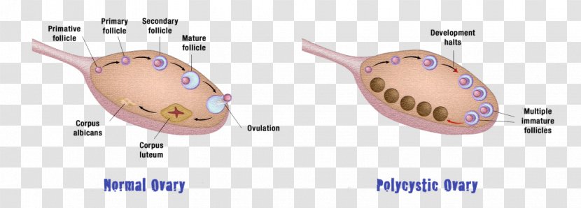 Polycystic Ovary Syndrome Ovarian Cyst Disease - Insulin Resistance - Health Transparent PNG