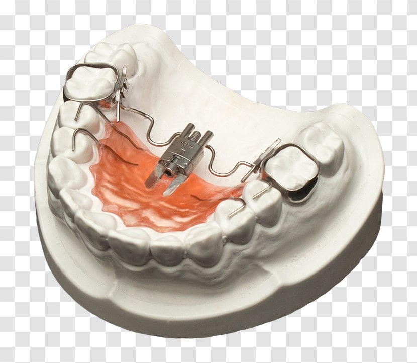 Tooth Jaw Orthodontics Orthodontic Technology Maxilla - Clear Aligners - Riga Transparent PNG