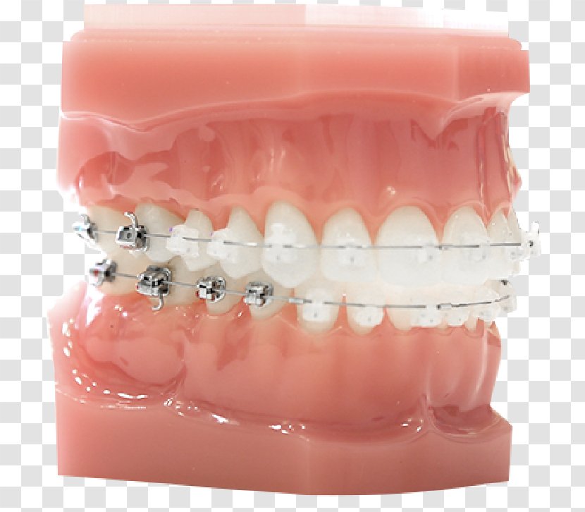 Tooth Damon System Dental Braces Dentistry ファミリエ歯科クリニック Transparent PNG