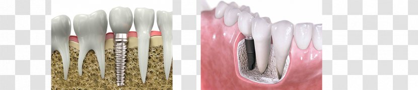 Prosthesis Prosthodontics Dentistry Dental Implant Tooth - Brush - Health Transparent PNG