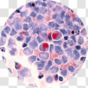 Acute Myeloid Leukemia Cancer Gemtuzumab Ozogamicin Lymphoblastic - Bone Marrow Transparent PNG