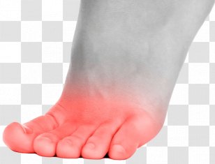 Toe Foot Ball Callus Disease - Cartoon - Gout Problems Transparent PNG