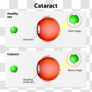 Cataract Surgery Intraocular Lens Human Eye Transparent PNG