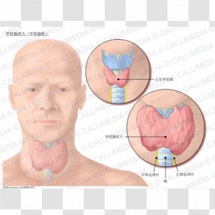 Nodule Goitre Graves' Disease Hyperthyroidism - Flower - Cartoon Transparent PNG