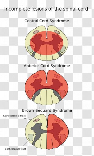 Spinal Cord Injury Anterior Artery Syndrome Central - Cartoon Transparent PNG