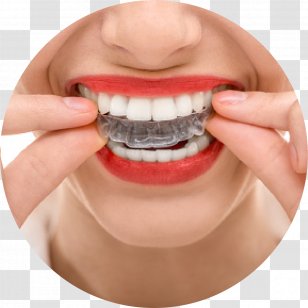 Orthodontics Dentistry Dental Braces Clear Aligners - Decayed Tooth Transparent PNG