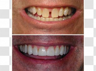 Tooth Veneer All-on-4 Dental Implant Dentistry - Smile - Crown Transparent PNG