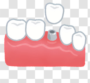 Icon - Dental Implant Illustration Transparent PNG
