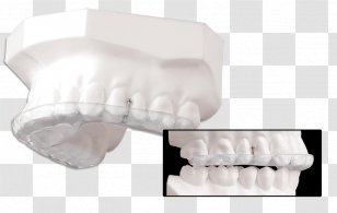 Splint Tooth Temporomandibular Joint Dysfunction Therapy Image - Jaw - Mandibular Advancement Splints Transparent PNG