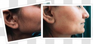 Hair Removal Facial Woman Human Growth - Jaw - Laser Transparent PNG